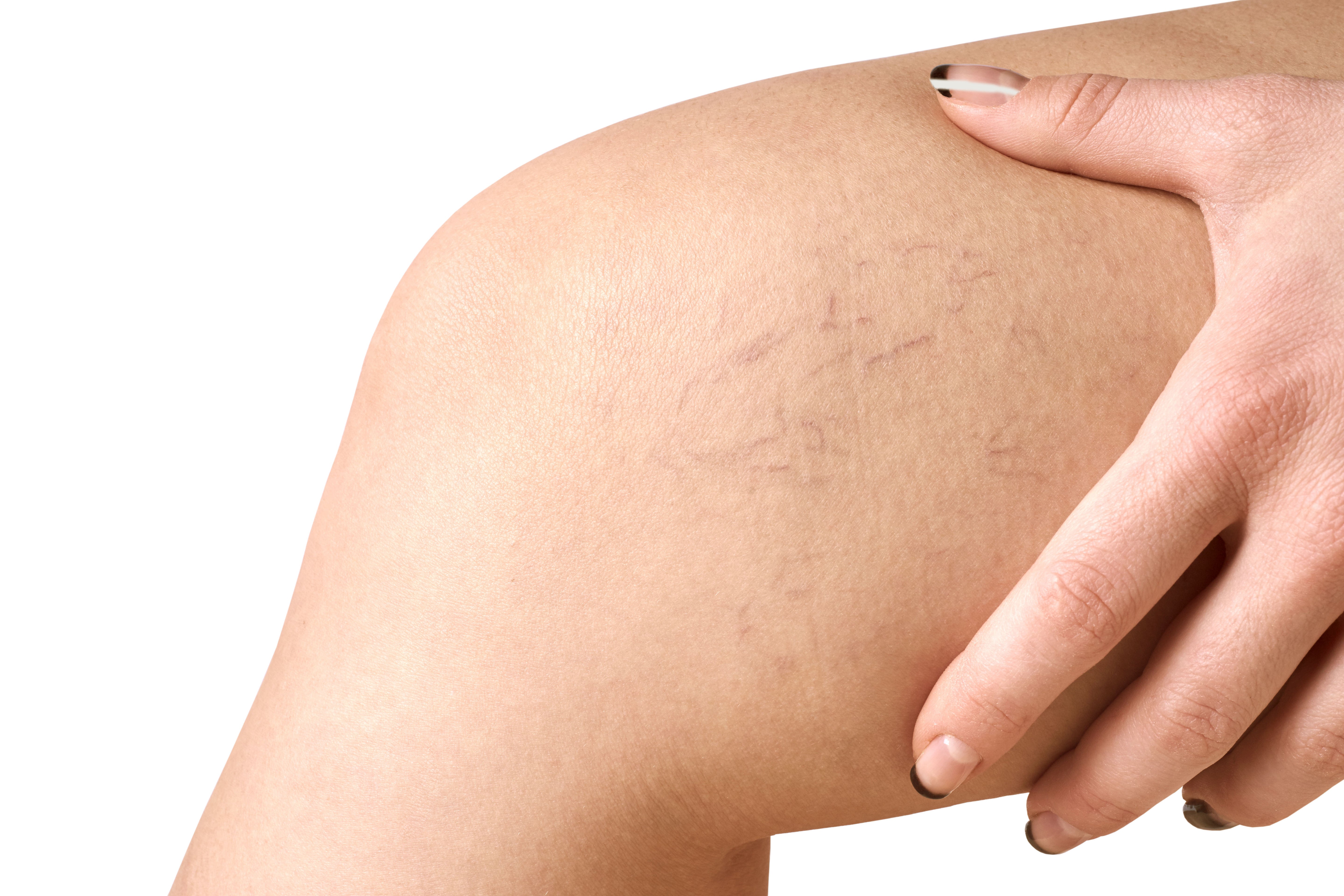 Thread Vein Removal — Legs (small area)