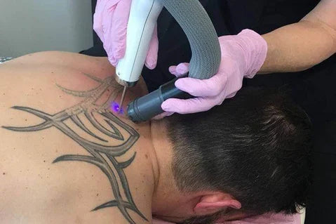 Laser Tattoo Removal with Cynosure Picosure — Large Size Tattoo