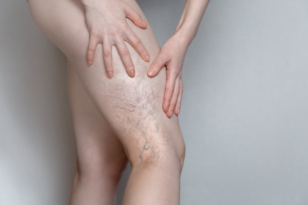 Thread Vein Removal — Legs (large area)