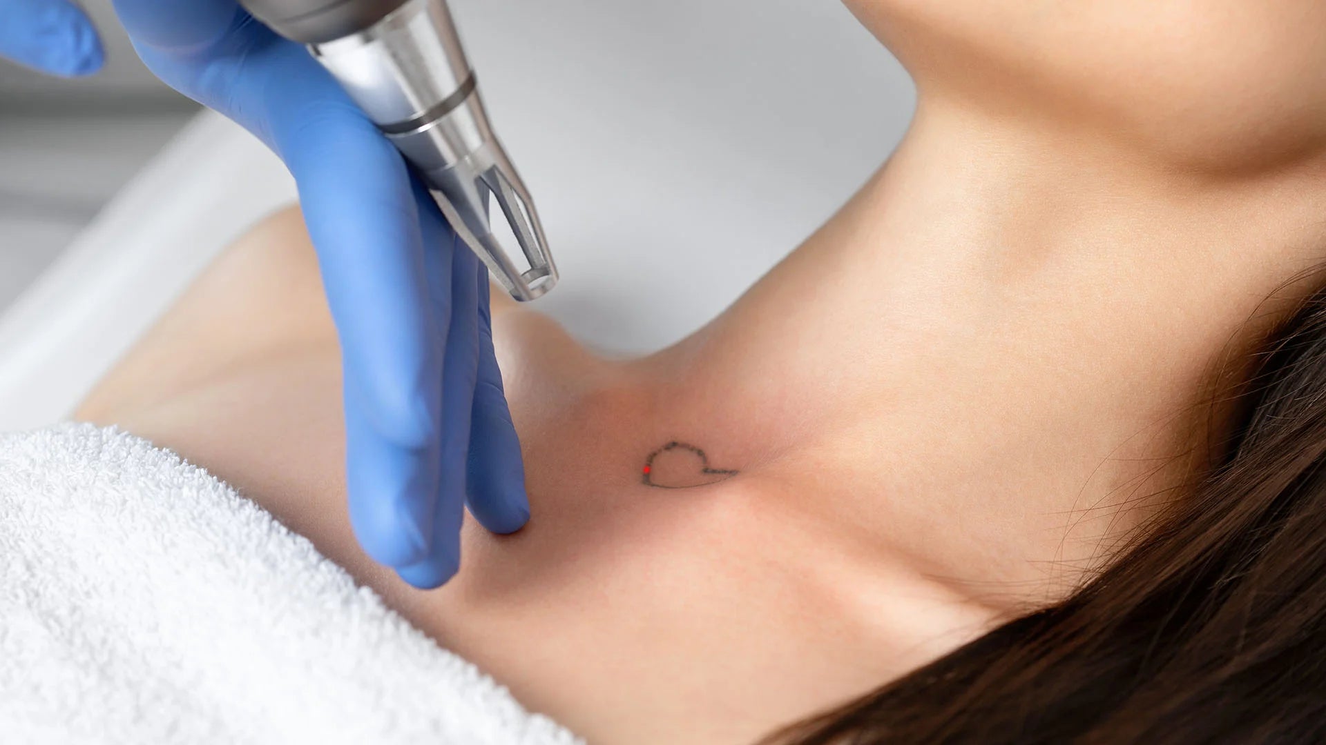 Laser Tattoo Removal with Cynosure Picosure  — Small Size Tattoo